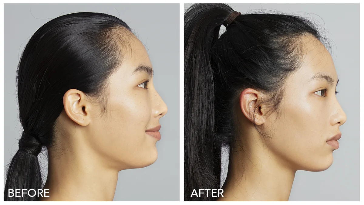 microcurrent before and after photo neck